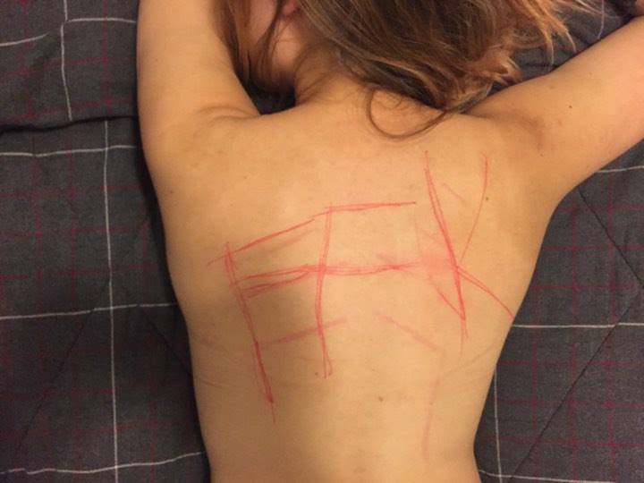 Girl with red markings on their back saying FFK lying on a checkered blanket